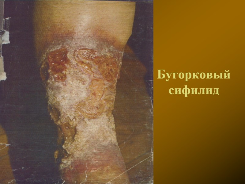 Бугорковый сифилид